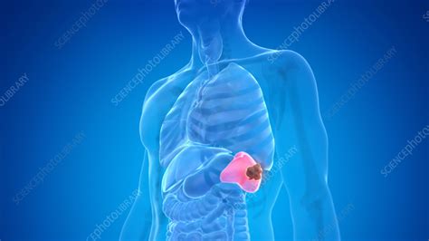 Spleen cancer, illustration - Stock Image - F035/2534 - Science Photo Library