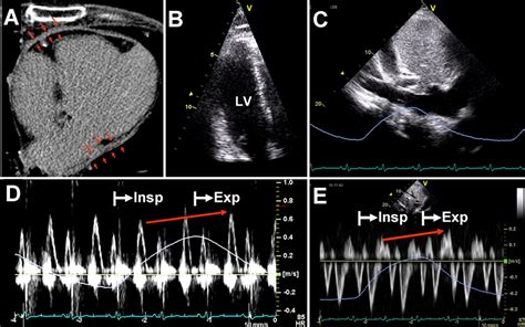 Role of Echocardiography in the Diagnosis of Constrictive Pericarditis - Journal of the American ...