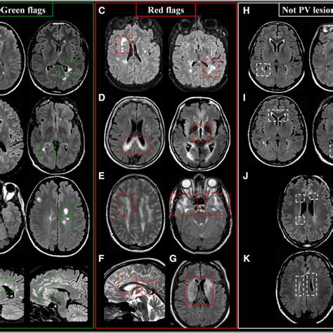 Characteristics of gadolinium-enhancing multiple sclerosis lesions that ...