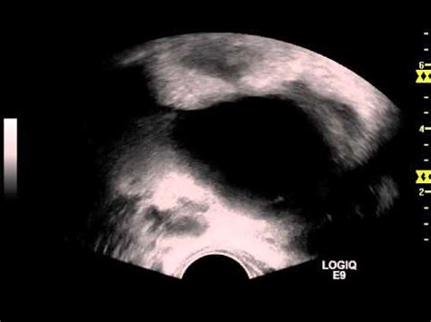 Ultrasound-guided Drainage of a Deep Pelvic Abscesses - Video 01 - YouTube