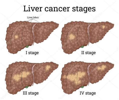 Ilustración de los cuatro estadios del cáncer de hígado 2022