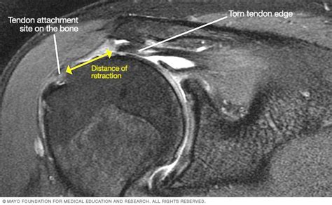 MRI of torn rotator cuff | Rotator cuff, Mri, Rotator cuff injury