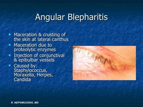 Ed&cornea lecture fatima