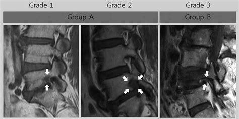 Grading for lumbar foraminal spinal stenosis in T1-weight sagittal MRI... | Download Scientific ...