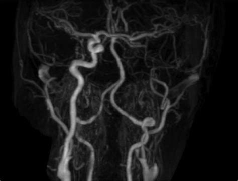 Occluded Left Internal Carotid Artery