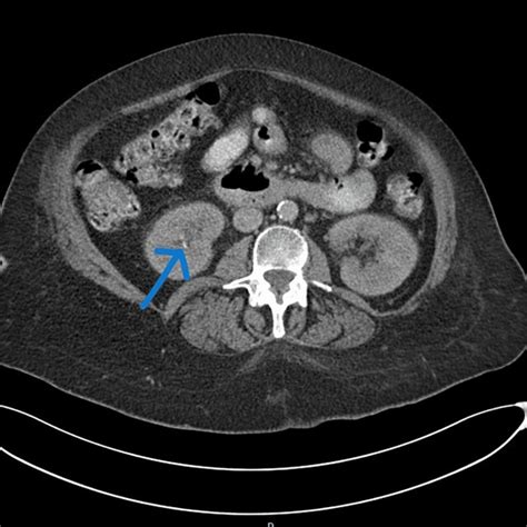 Axial view of the 4mm non-obstructing stone in the right kidney on the... | Download Scientific ...