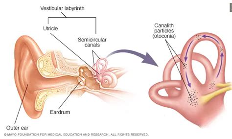 Benign Paroxysmal Positional Vertigo (BPPV) Definition | Brooks Rehabilitation