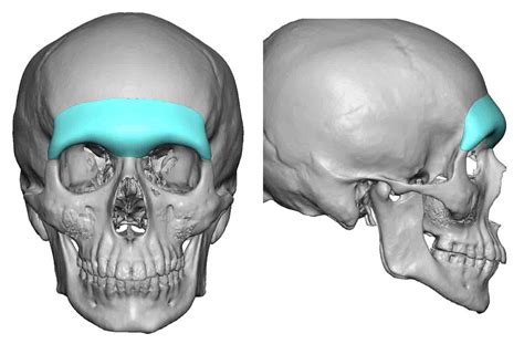 Custom Forehead Implants | Eppley Custom Facial Implants