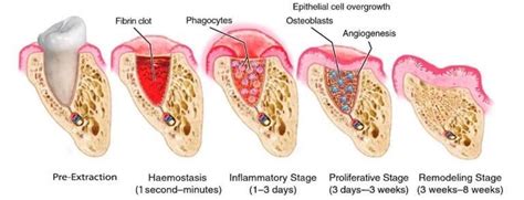 Typical Teeth Post-extraction Healing Stages : r/wisdomteeth