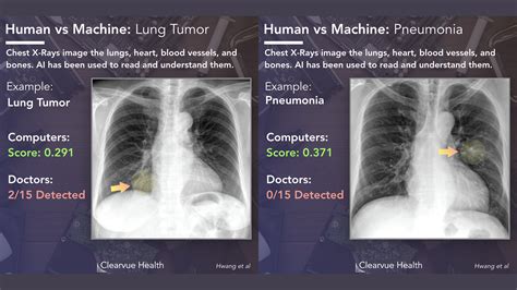 Bacterial Pneumonia X Ray