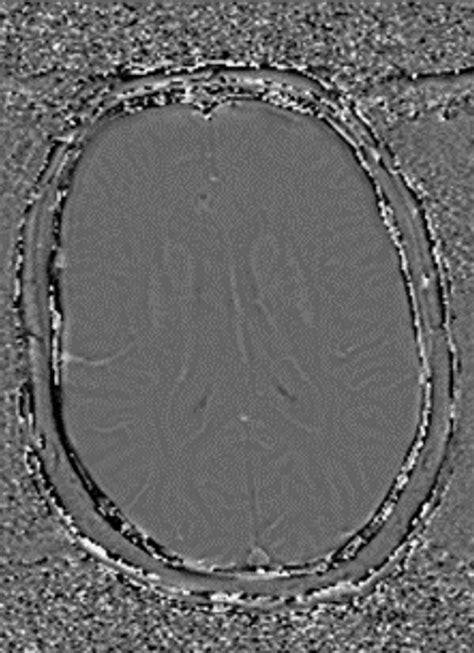 Phase-Contrast MRI: Physics, Techniques, and Clinical Applications | RadioGraphics