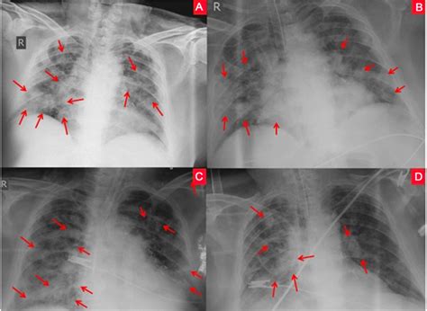 The Role of Chest X-Ray in Monitoring Lung Changes among COVID-19 Patients in Gaza Strip