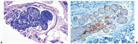 Lobular Carcinoma In Situ and Atypical Lobular Hyperplasia ...