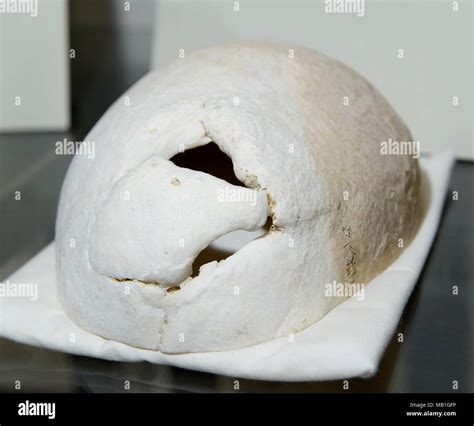 Phineas Gage skull, on display at Harvard Medical School. Hole in the cranium shows where ...