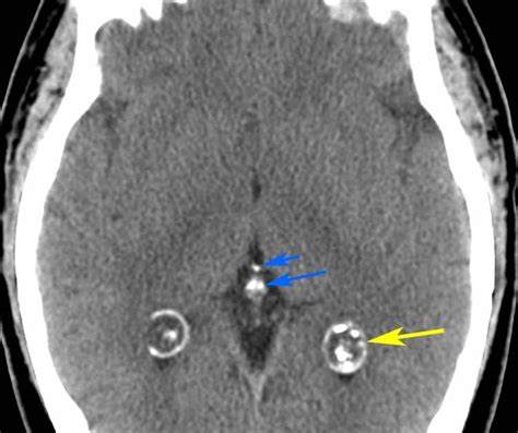 RiT radiology: Calcified Choroid Plexus Cysts