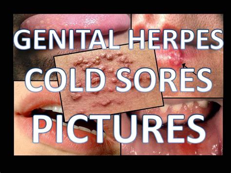 Early Stages of Herpes Pictures - YouTube