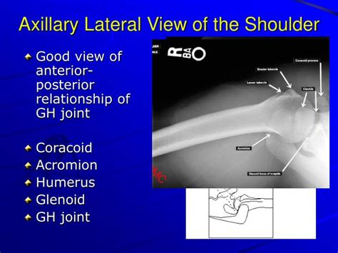 PPT - X-Ray Rounds: (Plain) Radiographic Evaluation of the Shoulder ...