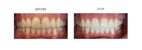 Benefits of Zoom Teeth Whitening: Before and After - Northside Dental Co.