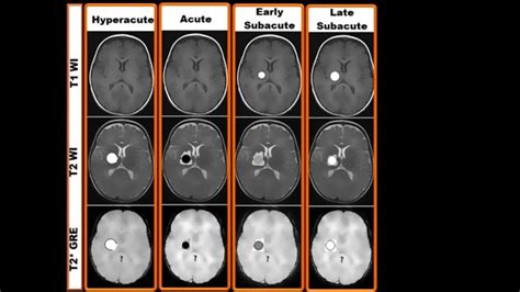 Mri Findings Of Different Stages Of Haemorrhage Youtube | Free Nude Porn Photos