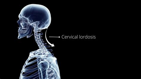 To Fix Reverse Cervical Lordosis Follow These 5 Easy Exercises