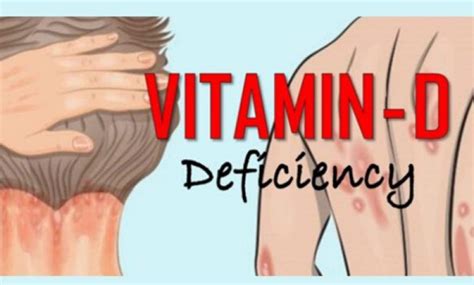 12 Serious Vitamin D Deficiency Symptoms You Need to Know