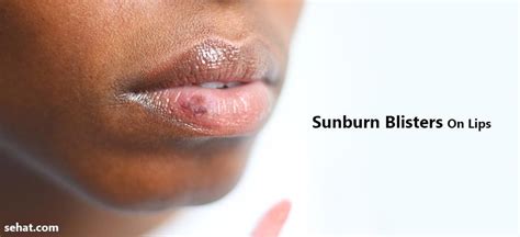 Sunburn Blisters On Lips- Causes And Tips To Get Rid