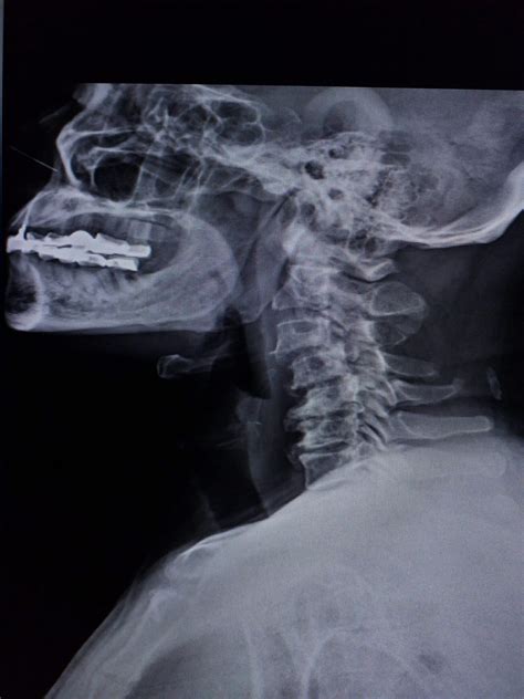 Retrolisthesis: Definition, Symptoms, Diagnosis, and Treatments - Spine Info