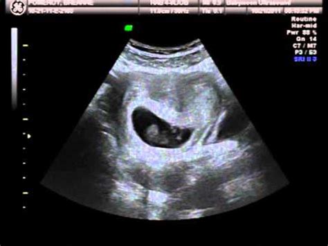 Vanishing Twin Syndrome Ultrasound