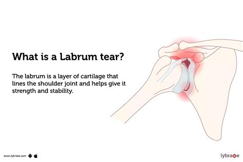 Labrum tear: Causes, Symptoms, Treatment and Cost