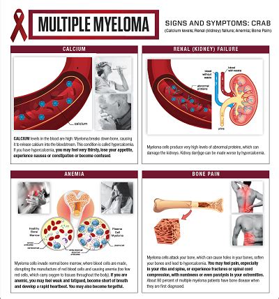 Multiple Myeloma Symptoms | Roswell Park Comprehensive Cancer Center