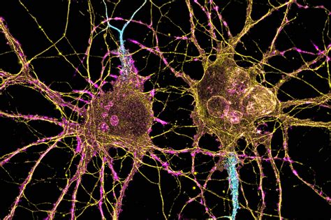 How Huntington’s disease affects different neurons | LaptrinhX / News