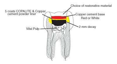 What is pulp capping