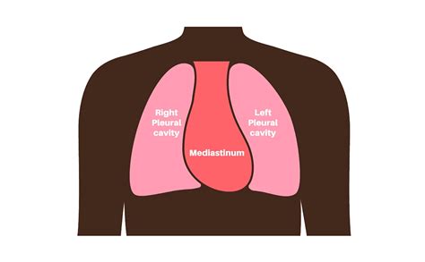 Mediastinal Tumor Surgery | Aurora Health Care