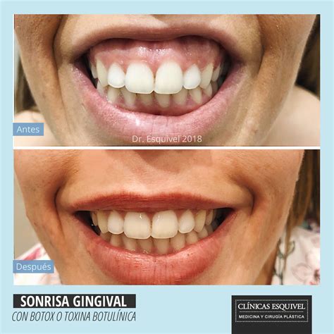 Sonrisa gingival