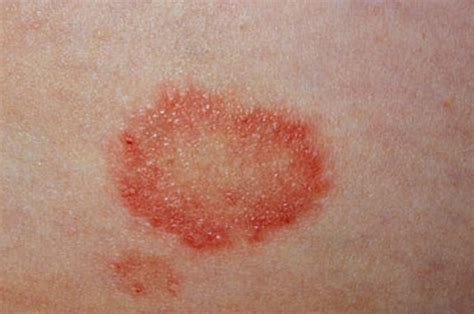 Ringworm – Images, Causes, Symptoms, Treatment | HubPages