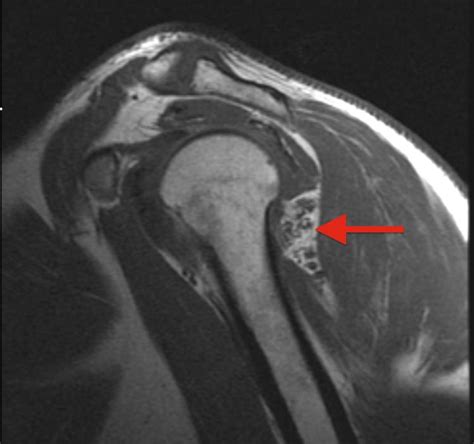 Quadrilateral Space Syndrome - Shoulder & Elbow - Orthobullets