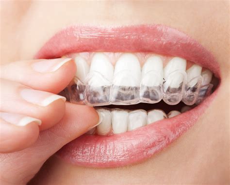 Four Fantastic Facts About Retainers