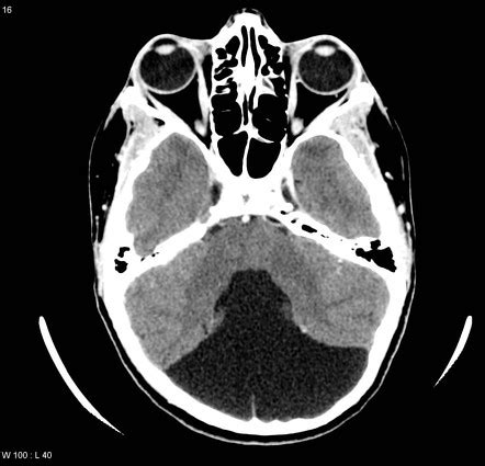 Mega cisterna magna | Radiology Reference Article | Radiopaedia.org