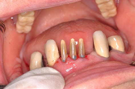 Dental Info: So many choices for crown preparation designs?