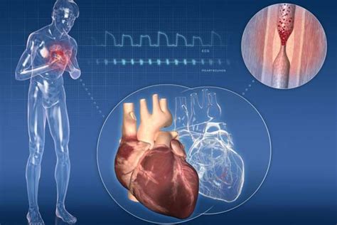 Ischaemic heart disease: chronic, definition, symptoms, consequences