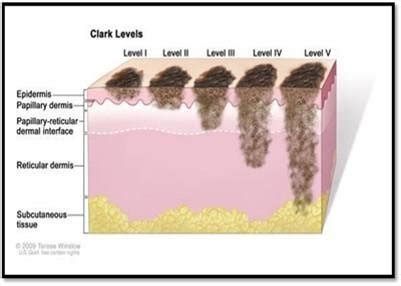 Stages Of Melanoma Skin Cancer Adapted With Permission From National ...