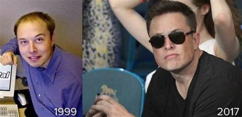 Elon Musk Before and After His Hair Transplant (Photo) – WRassman,M.D. BaldingBlog