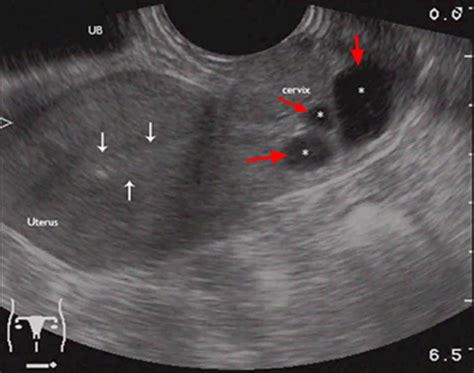 Nabothian cyst in cervix causes, symptoms & nabothian cyst treatment