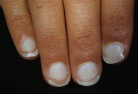 Nail Issues And Fungal Toe Care Tips - PRE-TEND Be curious - Travel