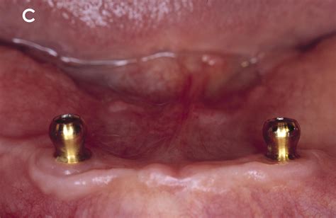 Implant Dentures (Complete)