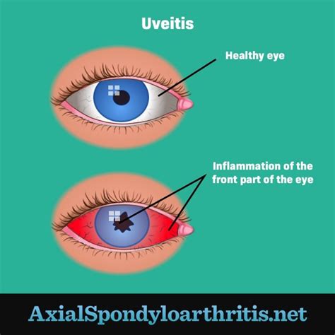 How Axial Spondyloarthritis Affects Vision