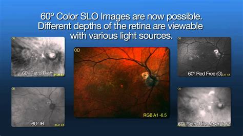 F-10 Scanning Laser Ophthalmoscope - YouTube