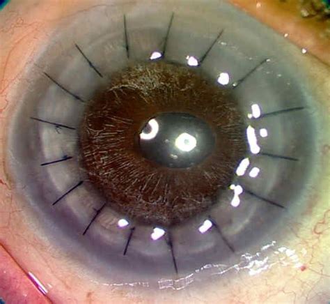 what is corneal surgery ? A cornea transplant (keratoplasty) is a ...