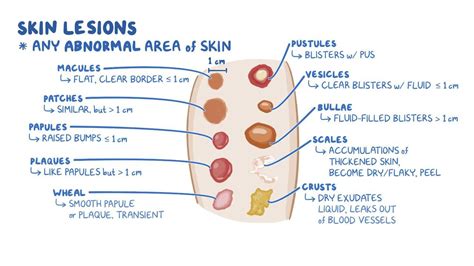 Integumentary system: Skin lesions - Osmosis Video Library