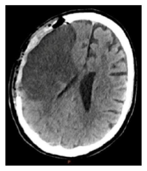 (a) Original CT angiogram revealing a dense right MCA sign. (b) Initial ...